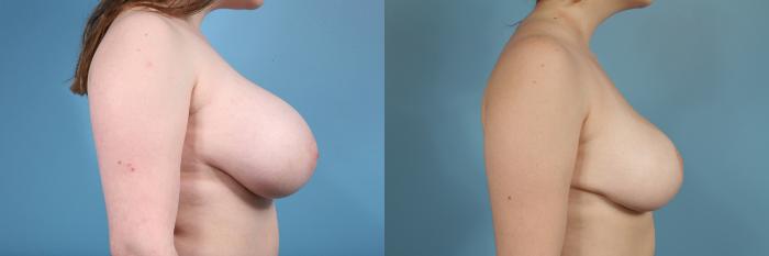 Before & After Breast Reduction Case 46 View #3 View in Chicago, IL