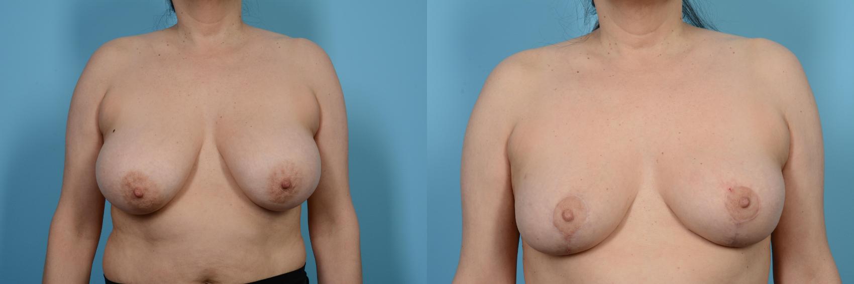 Before & After Breast Reduction Case 482 View #1 View in Chicago, IL