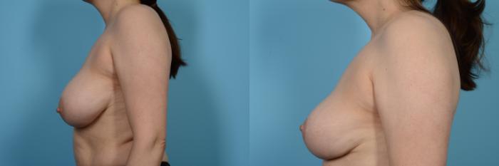 Before & After Breast Reduction Case 482 View #2 View in Chicago, IL