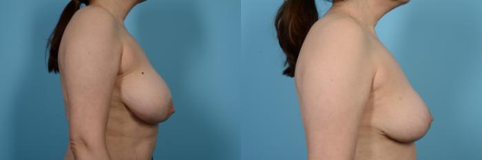 Before & After Breast Reduction Case 482 View #3 View in Chicago, IL