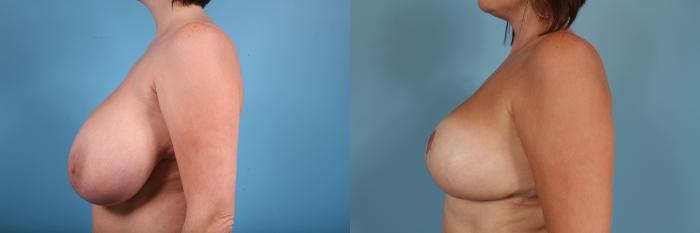 Before & After Breast Reduction Case 49 View #2 View in Chicago, IL
