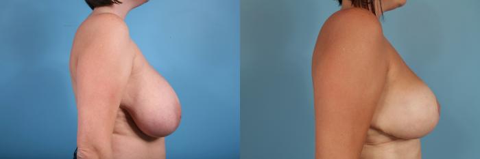 Before & After Breast Reduction Case 49 View #3 View in Chicago, IL