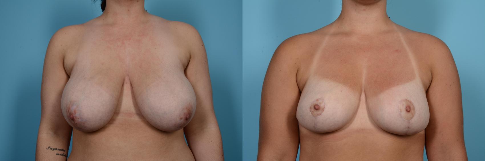 Before & After Breast Reduction Case 494 View #1 View in Chicago, IL