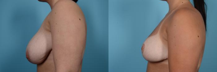 Before & After Breast Reduction Case 494 View #2 View in Chicago, IL