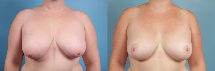 Before & After Breast Reduction Case 51 View #1 View in Chicago, IL