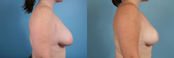 Before & After Breast Reduction Case 51 View #3 View in Chicago, IL
