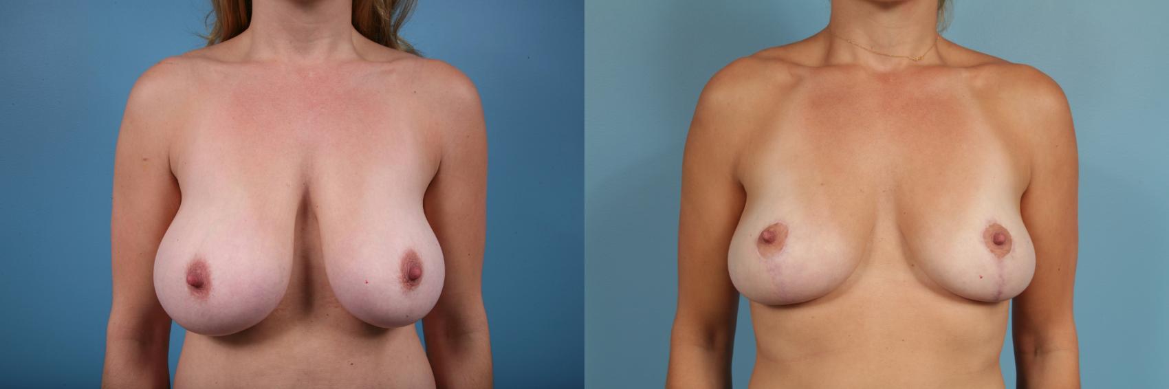 Before & After Breast Reduction Case 52 View #1 View in Chicago, IL