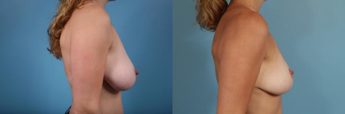 Before & After Breast Reduction Case 52 View #3 View in Chicago, IL