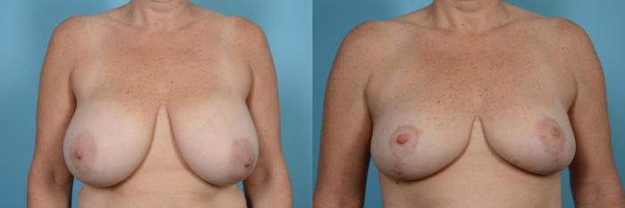 Before & After Breast Reduction Case 520 View #1 View in Chicago, IL