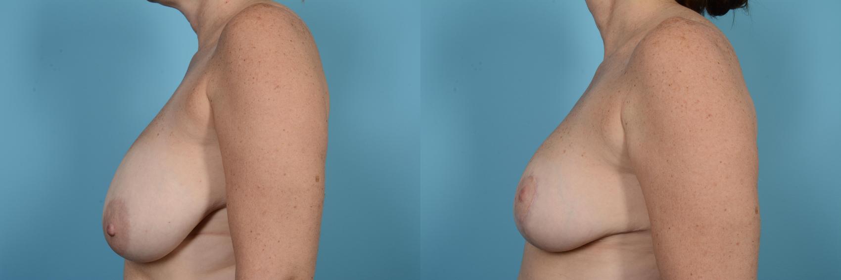 Before & After Breast Reduction Case 520 View #2 View in Chicago, IL