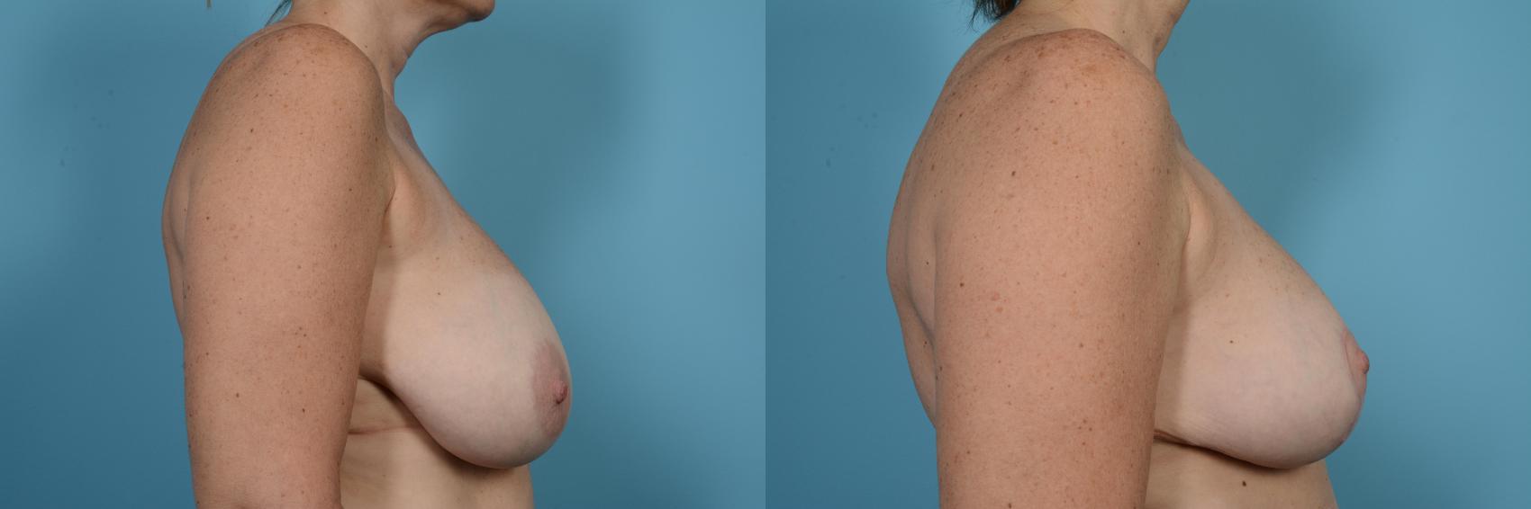 Before & After Breast Reduction Case 520 View #3 View in Chicago, IL