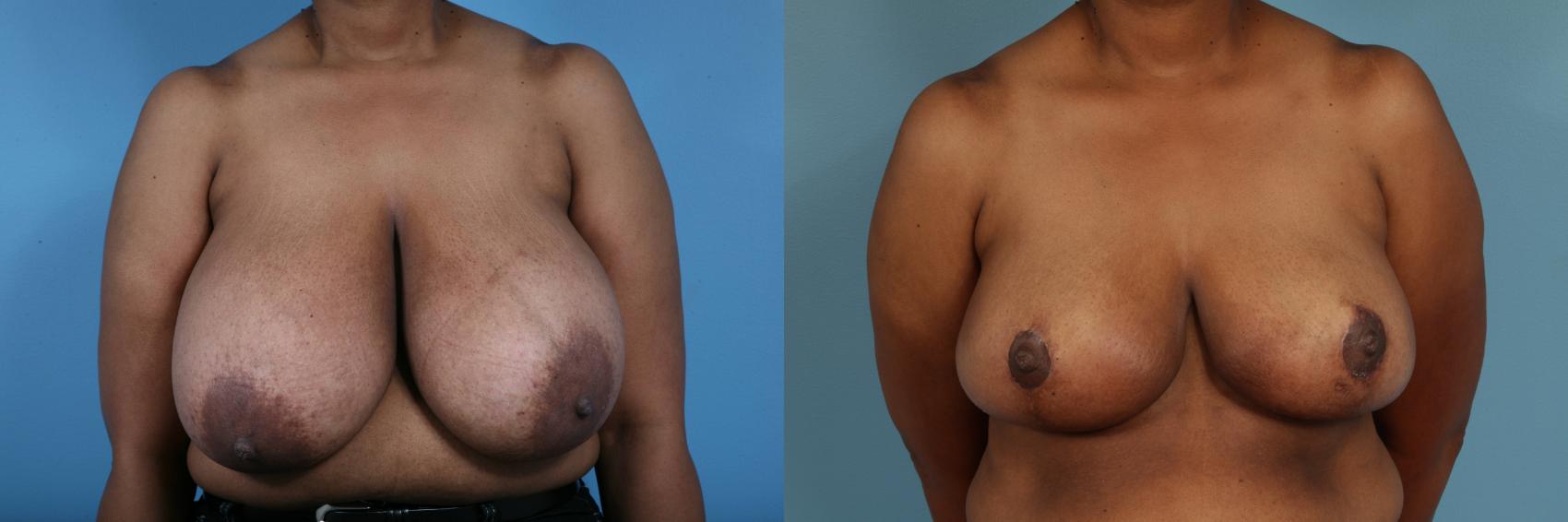 Before & After Breast Reduction Case 53 View #1 View in Chicago, IL