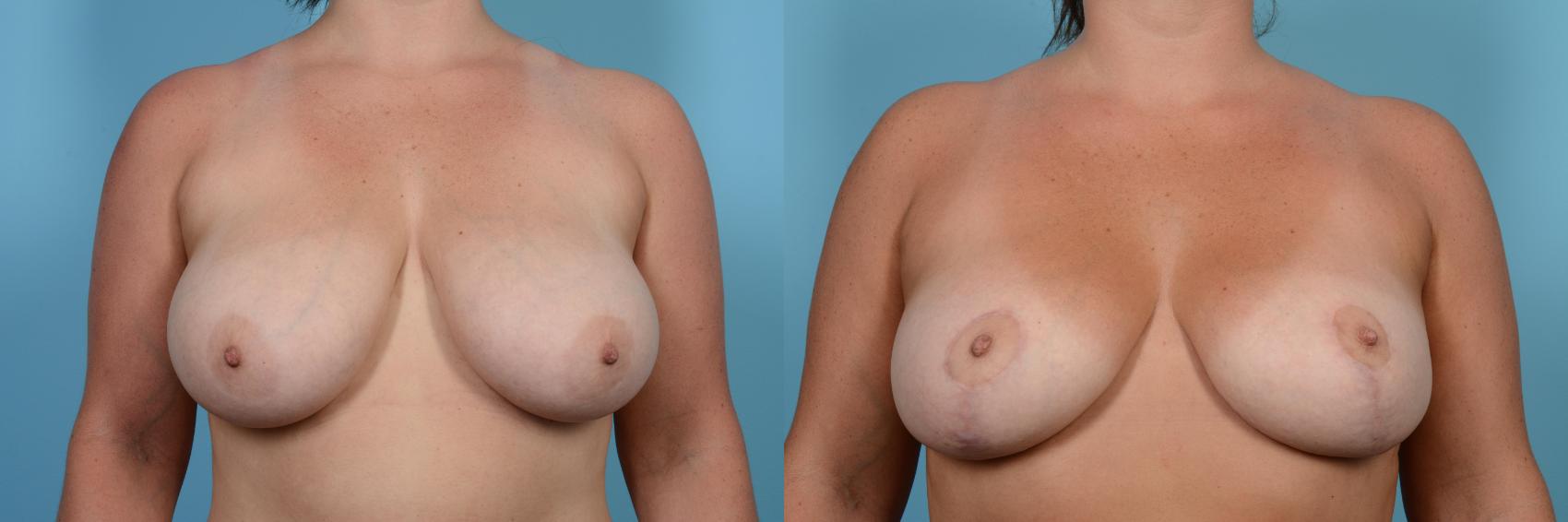 Before & After Breast Reduction Case 542 View #1 View in Chicago, IL