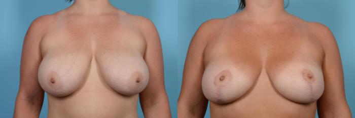 Before & After Breast Reduction Case 542 View #1 View in Chicago, IL