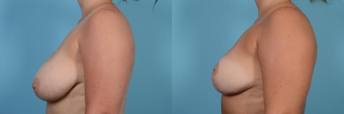 Before & After Breast Reduction Case 542 View #2 View in Chicago, IL