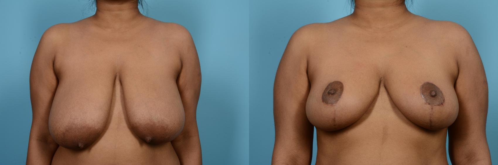 Before & After Breast Reduction Case 564 View #1 View in Chicago, IL