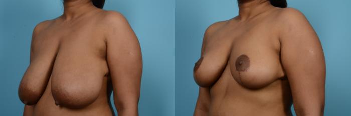 Before & After Breast Reduction Case 564 View #2 View in Chicago, IL