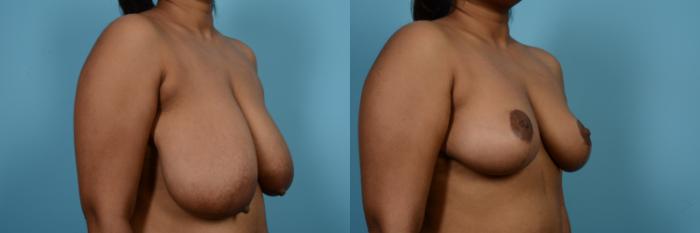 Before & After Breast Reduction Case 564 View #3 View in Chicago, IL