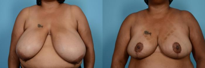 Before & After Breast Reduction Case 566 View #1 View in Chicago, IL