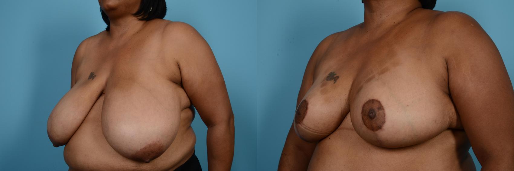 Before & After Breast Reduction Case 566 View #2 View in Chicago, IL