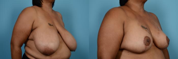 Before & After Breast Reduction Case 566 View #3 View in Chicago, IL