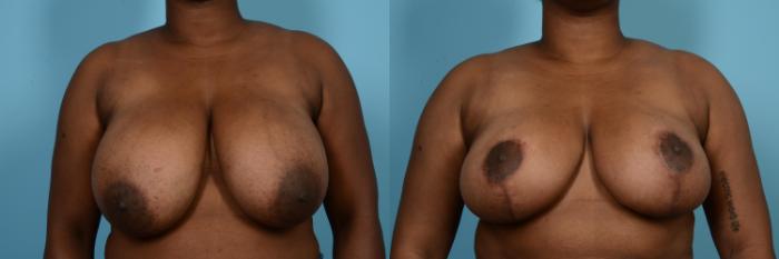 Before & After Breast Reduction Case 572 View #1 View in Chicago, IL