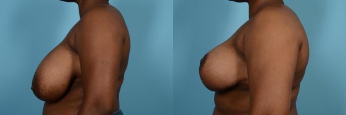 Before & After Breast Reduction Case 572 View #2 View in Chicago, IL