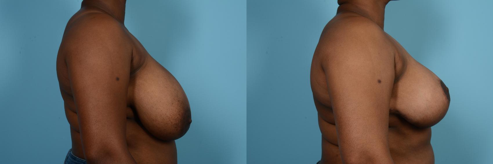 Before & After Breast Reduction Case 572 View #3 View in Chicago, IL