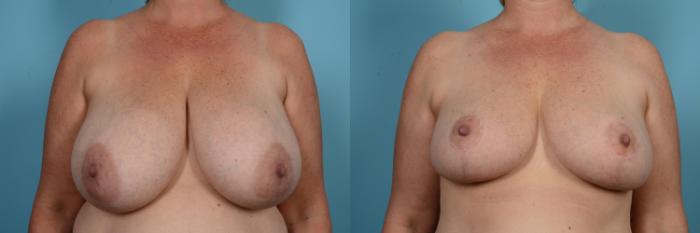 Before & After Breast Reduction Case 581 View #1 View in Chicago, IL