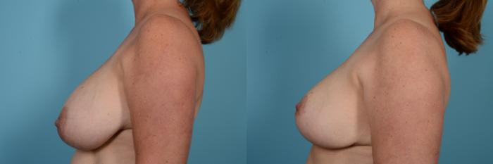 Before & After Breast Reduction Case 581 View #2 View in Chicago, IL