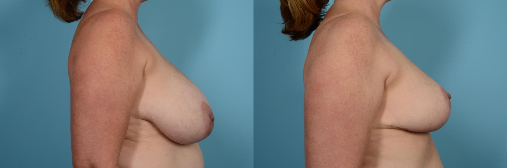 Before & After Breast Reduction Case 581 View #3 View in Chicago, IL