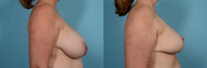 ABC 7 Chicago on X: Tex. woman gets life-changing surgery to reduce 36NNN  breasts. PHOTOS:   / X