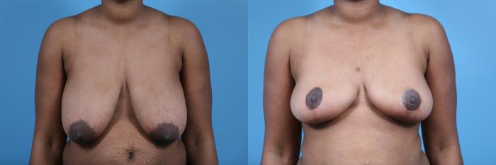 Before & After Breast Reduction Case 59 View #1 View in Chicago, IL