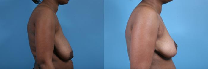 Before & After Breast Reduction Case 59 View #3 View in Chicago, IL