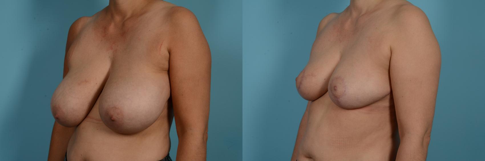 Dr. Sinno Breast Reduction in Chicago, Illinois