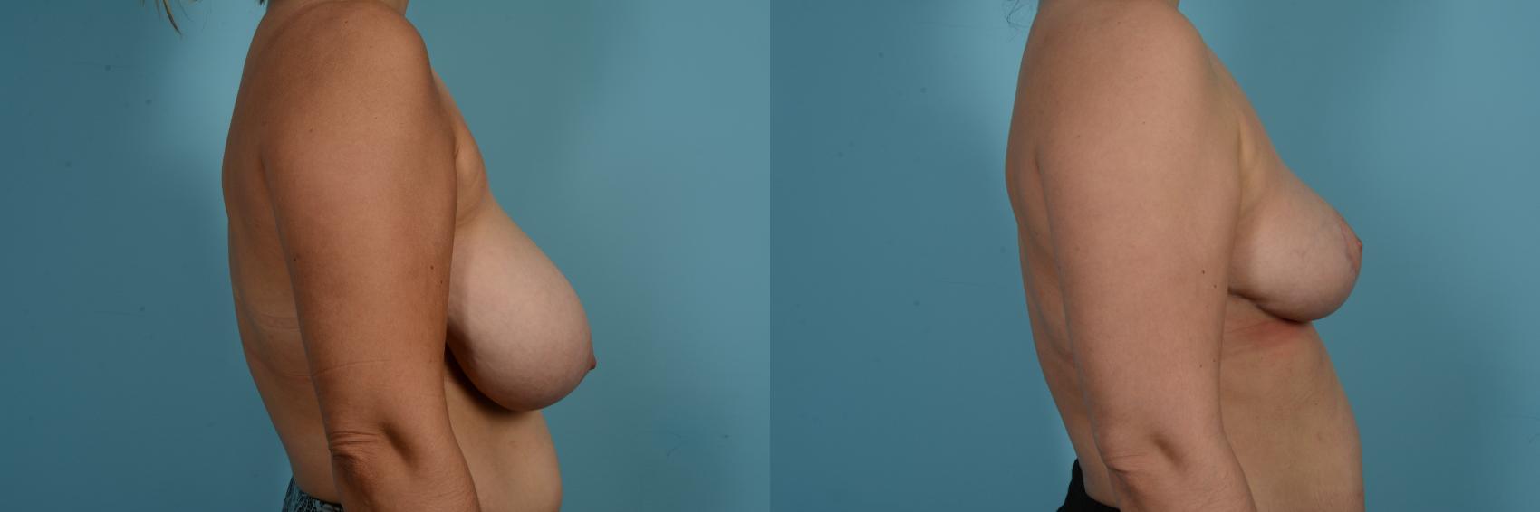 Dr. Sinno Breast Reduction in Chicago, Illinois