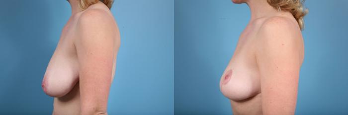 Before & After Breast Reduction Case 72 View #2 View in Chicago, IL