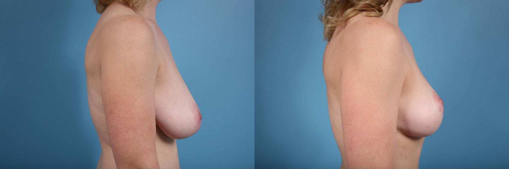 Before & After Breast Reduction Case 72 View #3 View in Chicago, IL