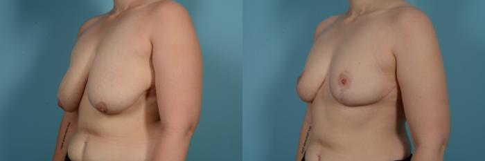Dr. Sinno Breast Reduction in Chicago, Illinois