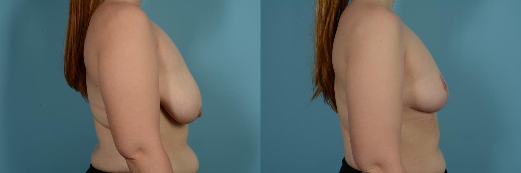 Dr. Sinno Breast Reduction in Chicago, Illinois
