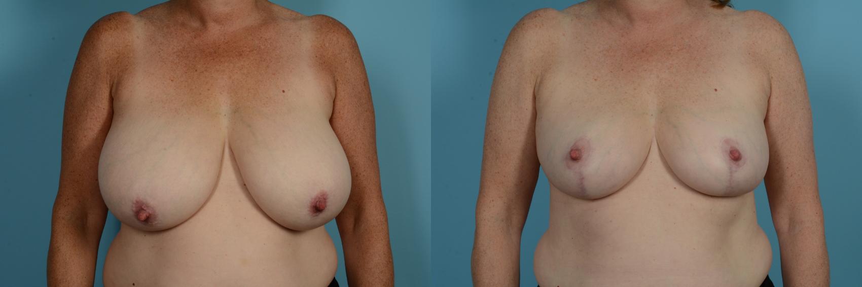 Dr. Sinno Breast Reduction in Chicago, Illinois