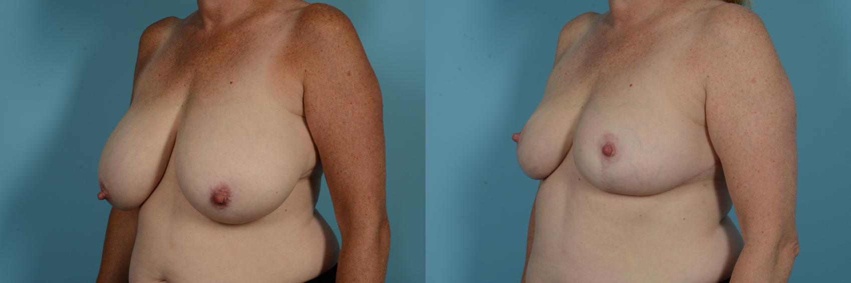 Dr. Sinno Breast Reduction in Chicago, Illinois