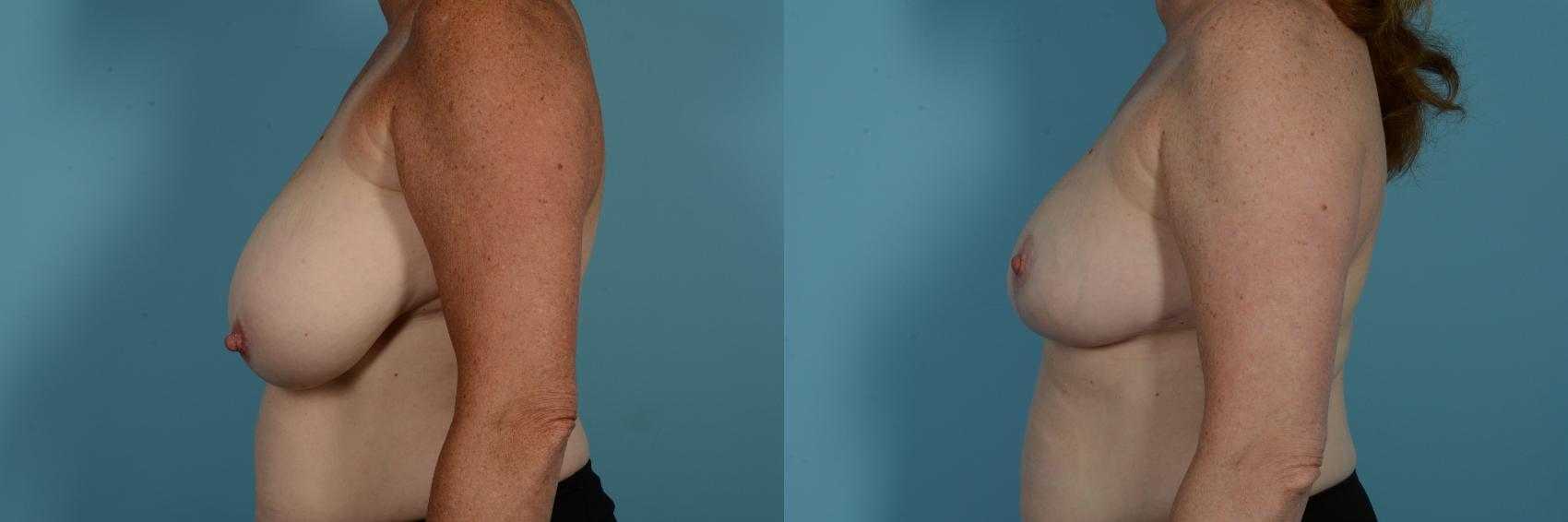 Dr. Sinno Breast Reduction in Chicago, Illinois
