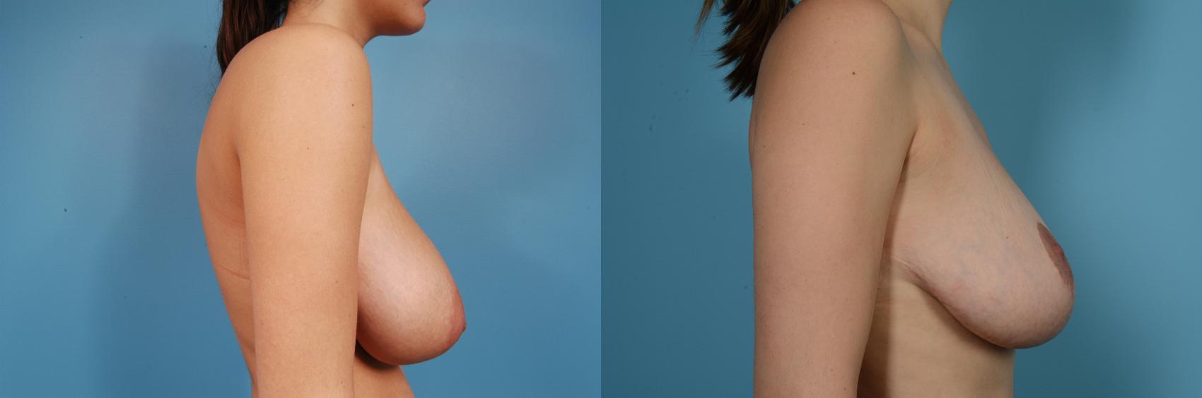 Before & After Breast Reduction Case 82 View #3 View in Chicago, IL