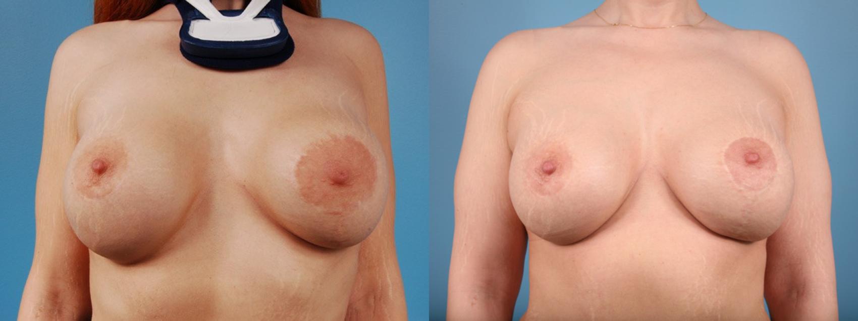 Before & After Breast Revision Surgery Case 2 View #1 View in Chicago, IL