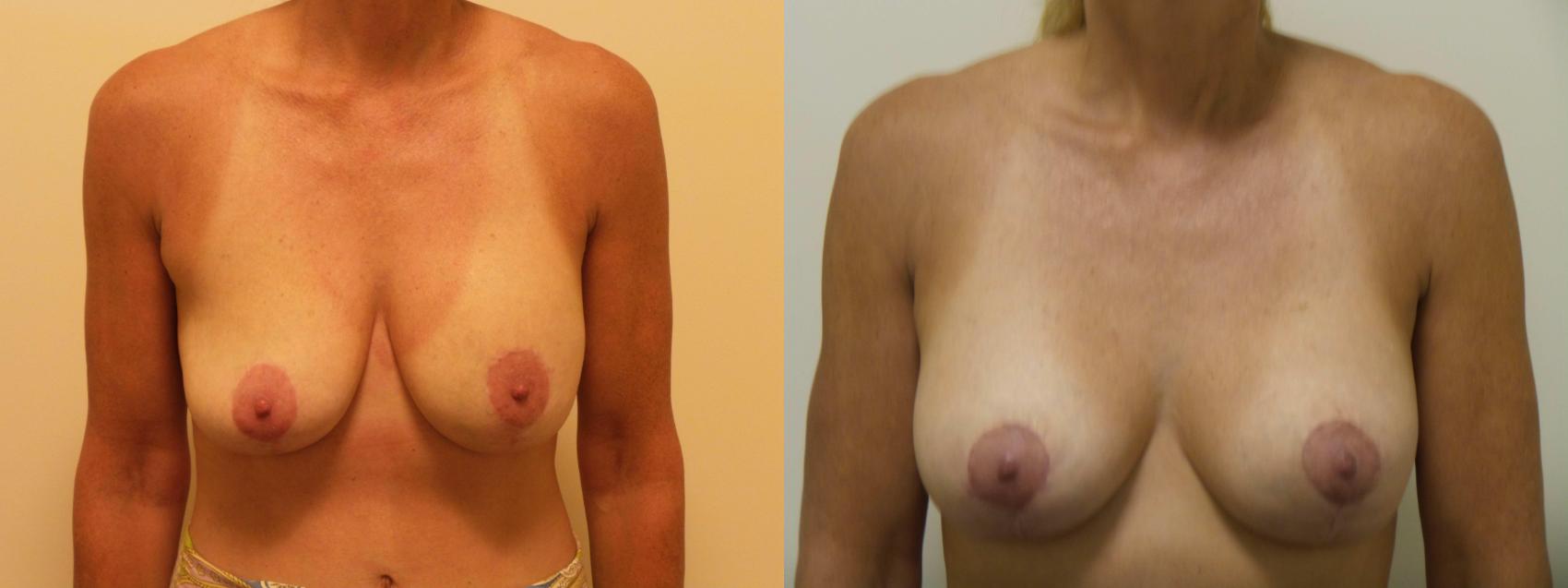Before & After Breast Revision Surgery Case 408 View #1 View in Chicago, IL