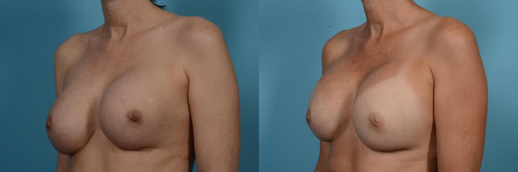 Before & After Breast Revision Surgery Case 556 View #2 View in Chicago, IL
