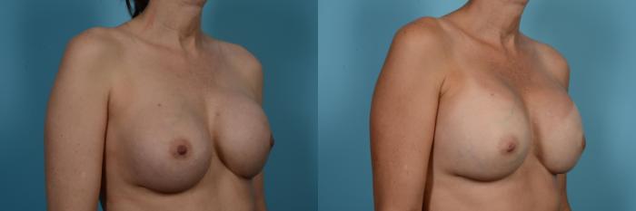Before & After Breast Revision Surgery Case 556 View #3 View in Chicago, IL