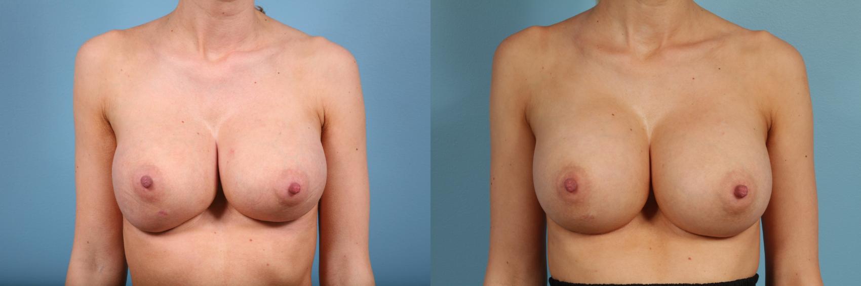 Before & After Breast Revision Surgery Case 56 View #1 View in Chicago, IL