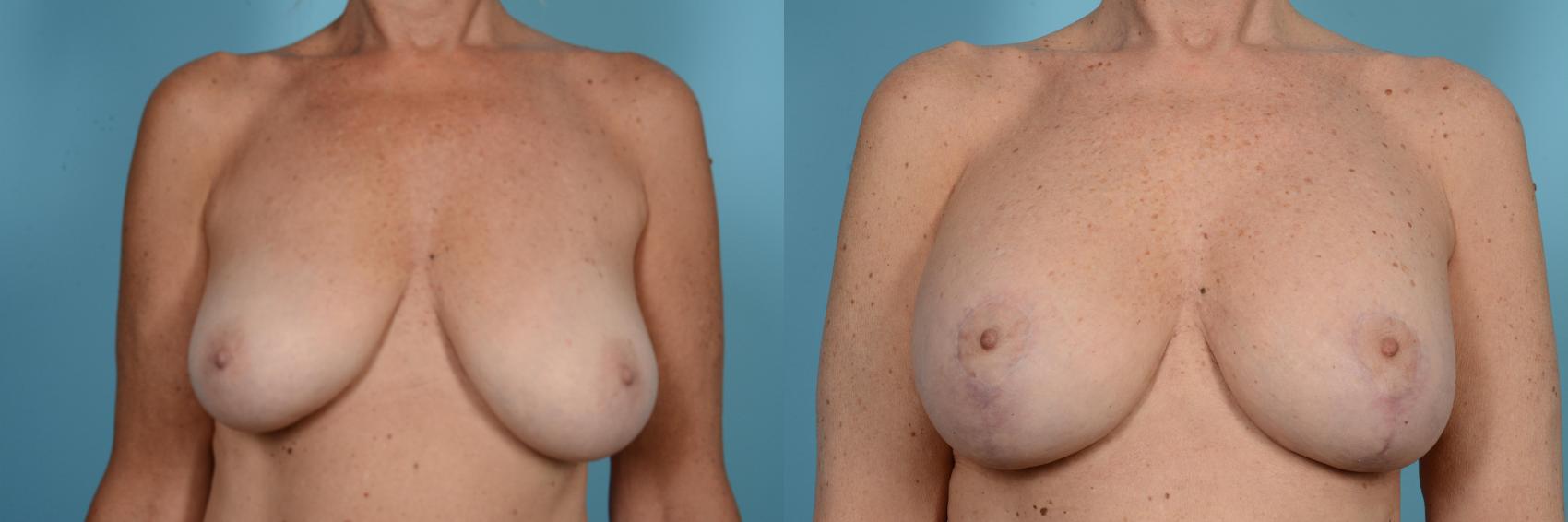 Before & After Breast Revision Surgery Case 582 View #1 View in Chicago, IL